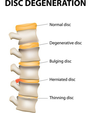 Disc Degeneration and IDD Therapy